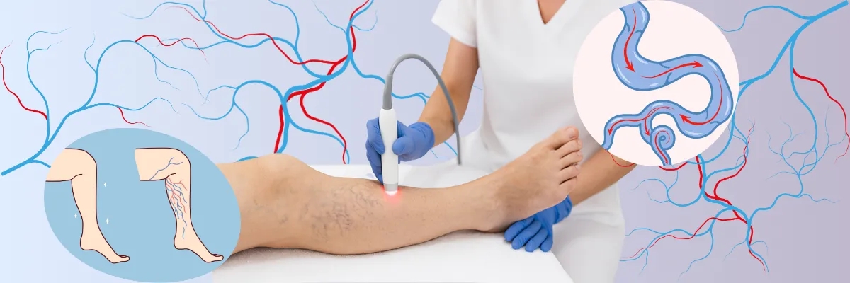 درمان واریس پا با لیزر: مراحل، مزایا و مراقبت‌های بعد از آن