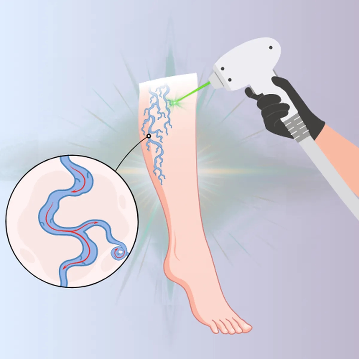 درمان واریس پا با لیزر: مراحل، مزایا و مراقبت‌های بعد از آن