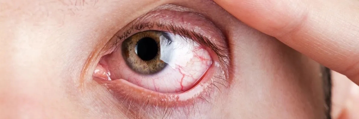 رتینوپاتی دیابتی چیست؟ علائم و راه‌های درمان