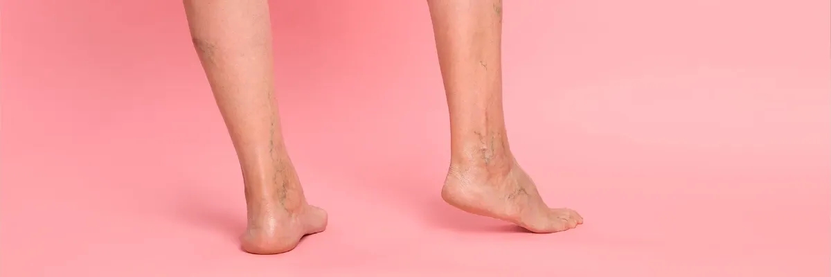 واریس عنکبوتی: علائم، علل و روش‌های درمانی