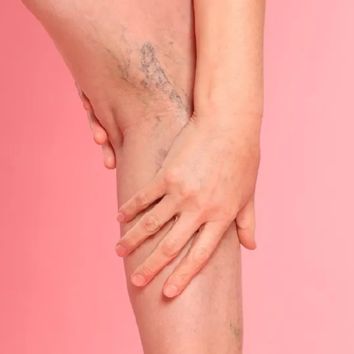 واریس عنکبوتی: علائم، علل و روش‌های درمانی