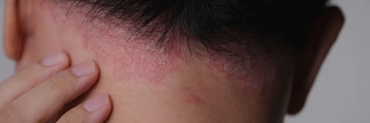 پسوریازیس پوست سر: راهنمای کامل تشخیص، علل و درمان