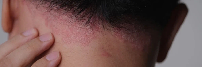 پسوریازیس پوست سر: راهنمای کامل تشخیص، علل و درمان