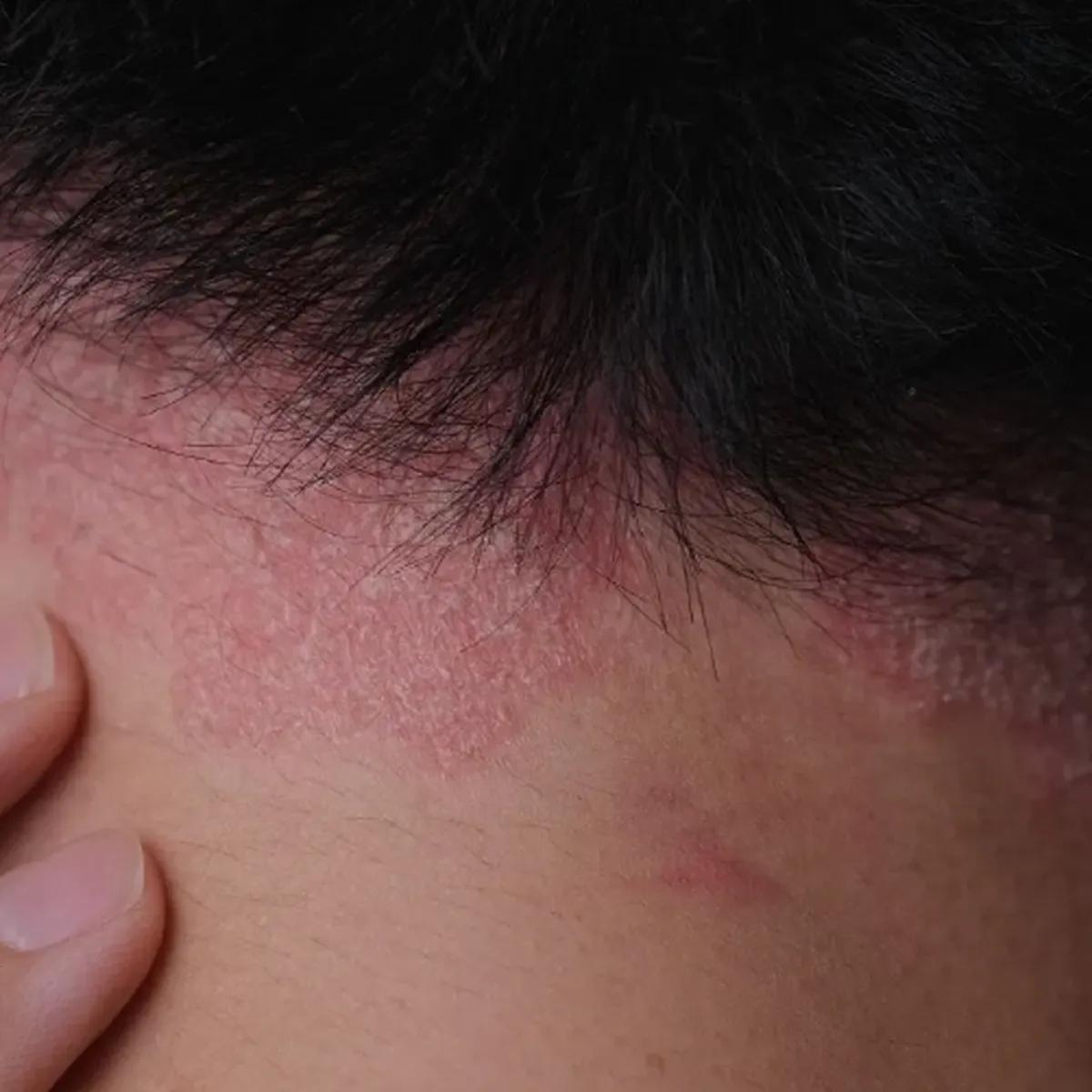 پسوریازیس پوست سر: راهنمای کامل تشخیص، علل و درمان