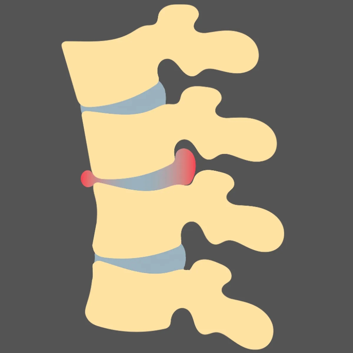 علائم تنگی کانال نخاعی چیست؟ 10 علامت هشدار دهنده که نباید نادیده بگیرید!