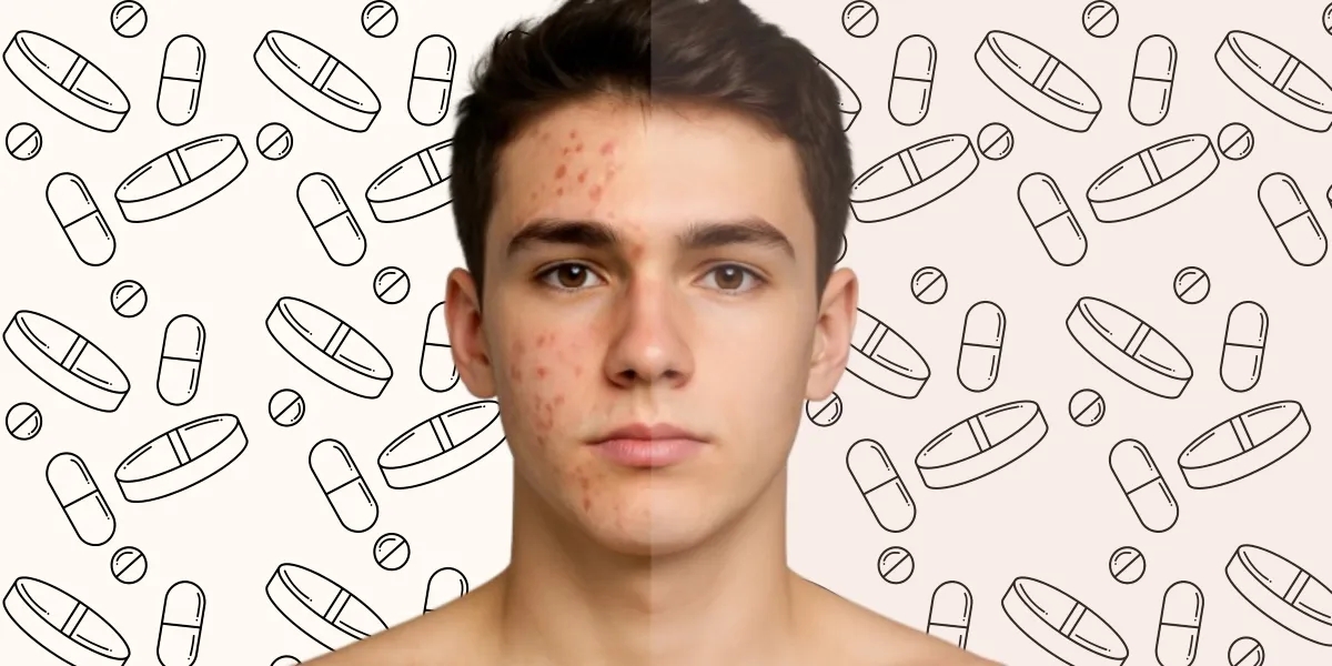قرص راکوتان چیست؟ درمان جوش و آکنههای شدید پوستی | فواید و عوارض